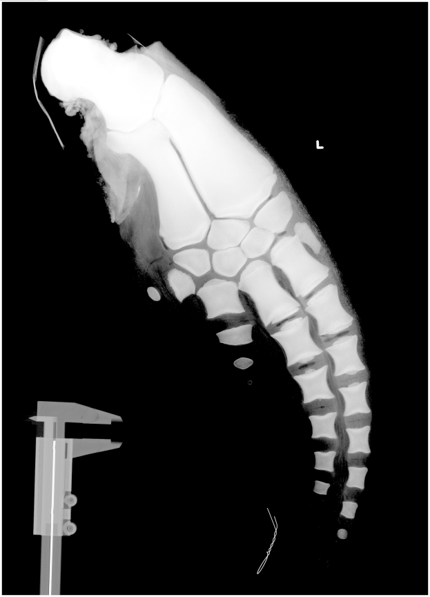 Ein Röntgenbild eines Männerbeins mit einer Fraktur in der Mitte, mit einem Metallband auf der linken Seite, vor einem schwarzen Hintergrund.