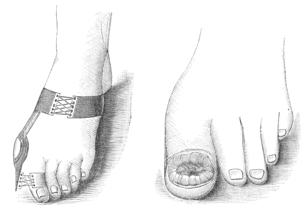 Schwarze und weiße Zeichnung von einem Paar Füße, eines mit einem Verband und das andere mit einer Fraktur, mit Text unten, der die Behandlung angibt.