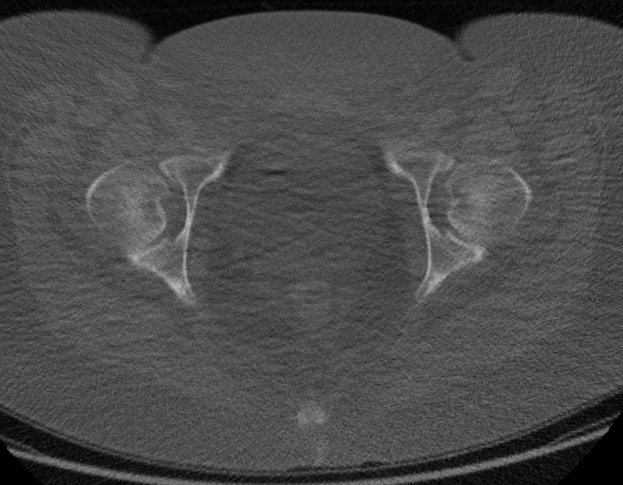 Eine Schwarz-Weiß-MRI-Aufnahme des Abdomens eines Mannes, die auf die Prostata fokussiert ist und detaillierte anatomische Strukturen zeigt.